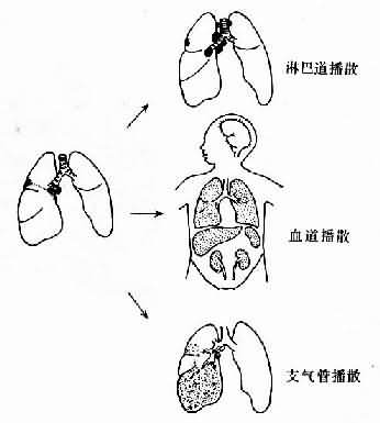 肺原发性结核病播散途径示意图