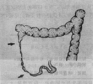 肠结核（溃疡型）