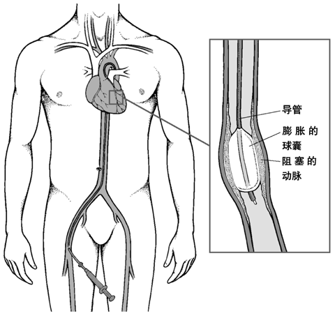 冠状动脉成形术