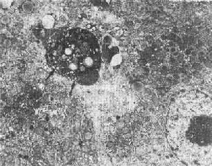 肝细胞凋落小体（左上）
