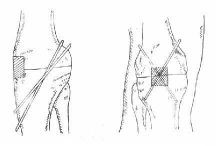 膝关节融合术