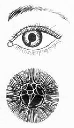 虹膜缺损与瞳孔膜存留