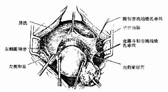 阔韧带前叶和腹膜反折全部切开及右侧输尿管的走向示意图