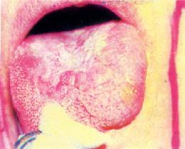 白斑癌变(舌背)