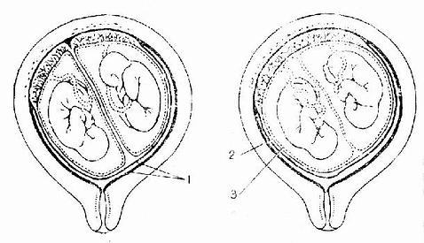 双胎胎盘与胎膜
