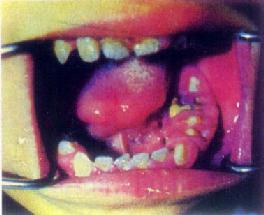舌及口底癌(左)