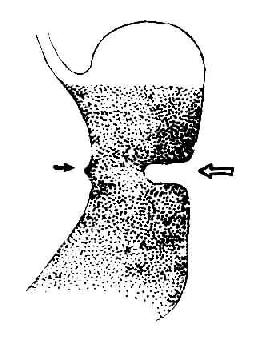 胃溃疡——大弯侧痉挛切迹