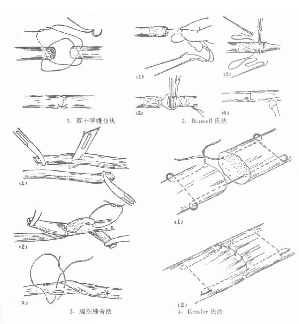 肌腱的各种缝合法