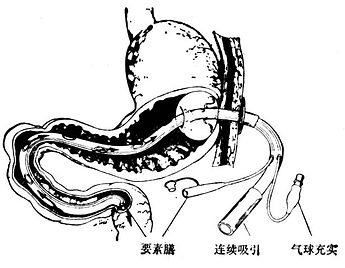 三腔空肠管原理图解图片