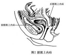 膀胱疝气图片