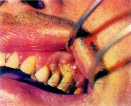 龈癌(左上牙龈)