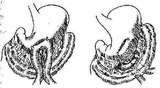 胃空肠吻合术之模式