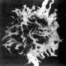 毛细胞性白血病细胞