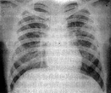 左肺浸润型肺结核空洞形成