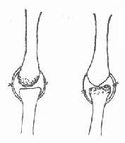 保留掌骨或近节指骨有完整关节面之一端，修整另一端，缝合关节囊，形成假关节
