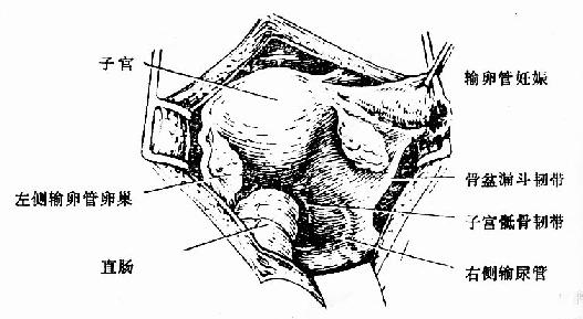 右侧输卵管妊娠